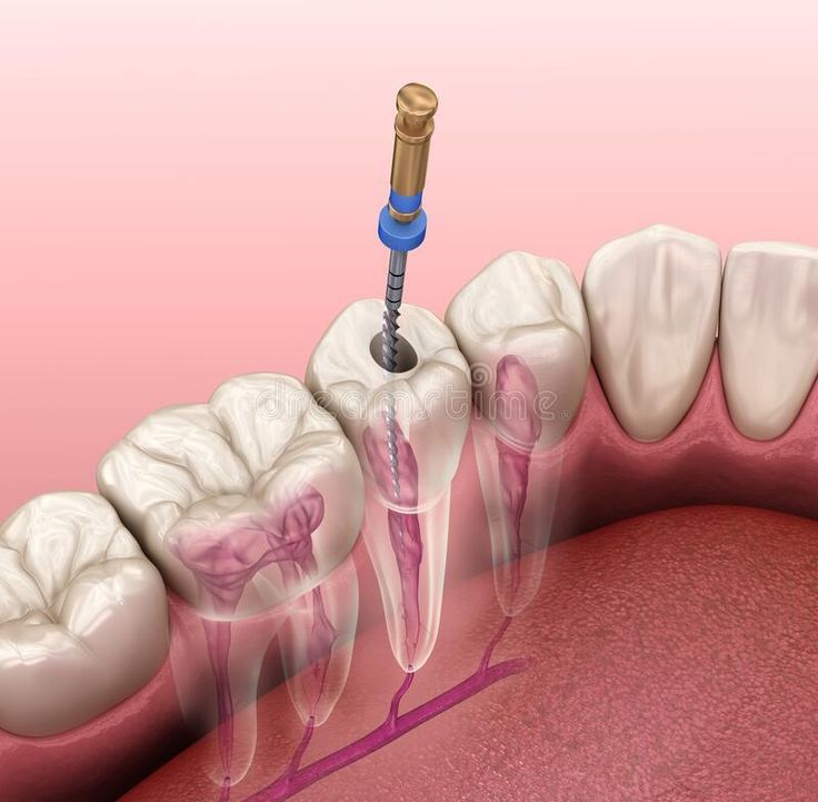 dental implants