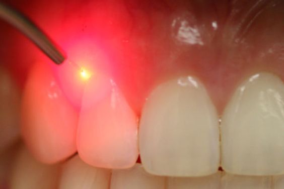 laser dentistry1
