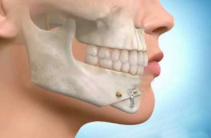 oral and maxila surgery
