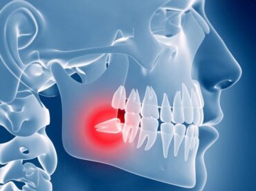 Wisdom tooth removal