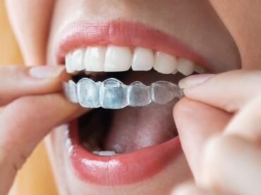 ClearAligners