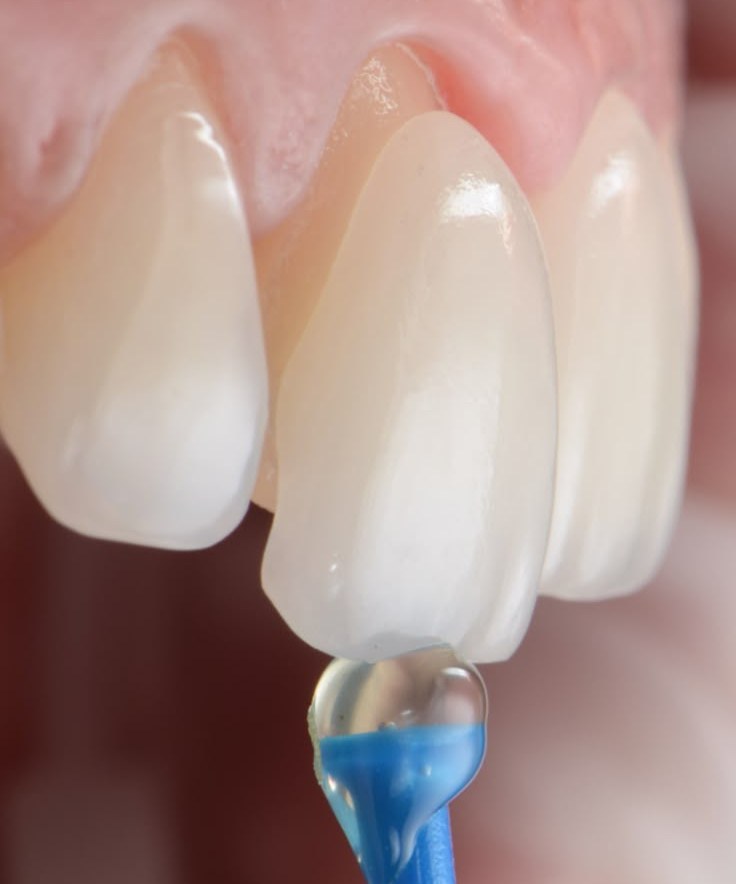 zirconia crowns